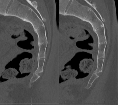 CT Scan lateral